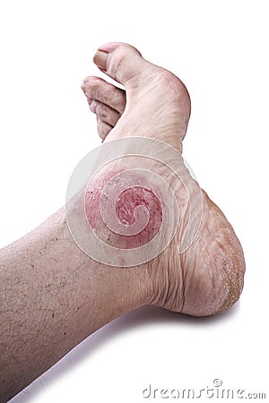 Psoriasis, skin disease Stock Photo