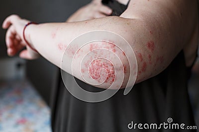 Psoriasis skin. Psoriasis is an autoimmune disease that affects the skin cause skin inflammation red and scaly. Eczema Stock Photo