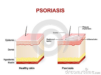 Psoriasis Vector Illustration