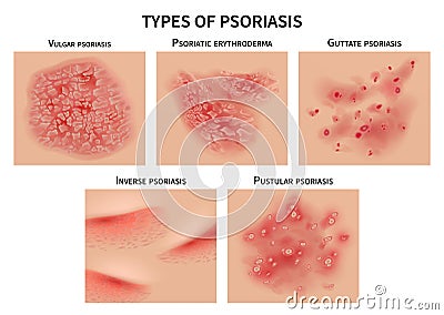 Psoriasis types. Skin hives, derma diseases. Closeup medical vector illustration Vector Illustration