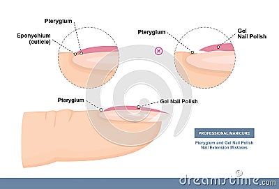 Pterygium and Gel Nail Polish. Nail Extension Mistakes. Professional Manicure Tutorial. Vector Vector Illustration