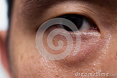 Ptosis Droopy eyelid in asian male oily skin type with dark eye bag Stock Photo