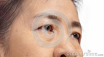 The ptosis or droopy eyelids in asian senior woman Stock Photo