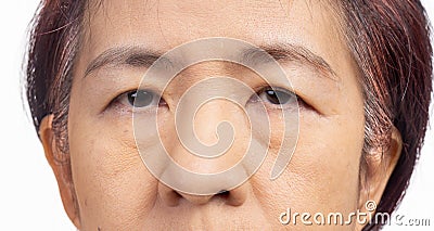 The ptosis or droopy eyelids in asian senior woman Stock Photo