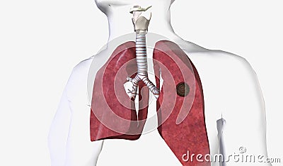 Pulmonary aspergilloma is a mass caused by a fungal infection th Stock Photo