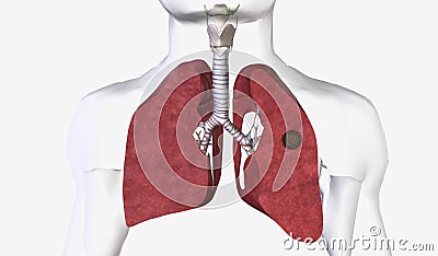 Pulmonary aspergilloma is a mass caused by a fungal infection th Stock Photo