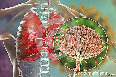 Pulmonary aspergillosis, invasion of a lung tissue by mold fungi Aspergillus with closeup view of the fungi, 3D Cartoon Illustration