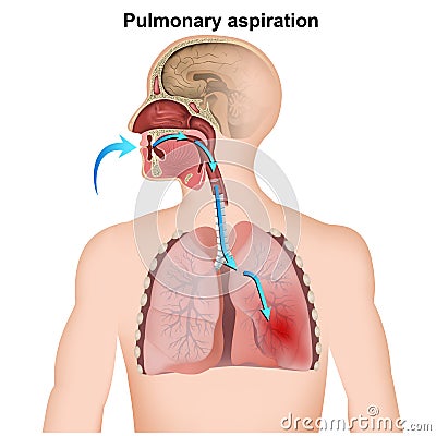 Pulmonary aspiration medical infographic on white background Vector Illustration