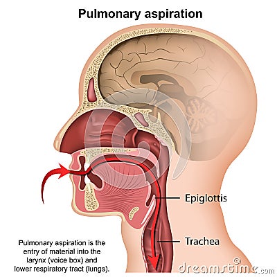 Pulmonary aspiration medical vector illustration isolated on white background Vector Illustration