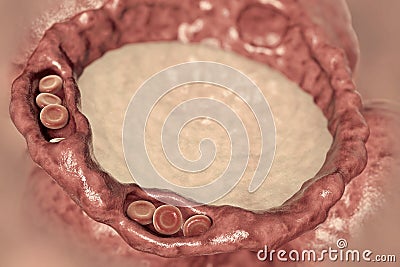 Pulmonary edema, close-up view of alveolus cross-section showing liquid in alveolus Cartoon Illustration