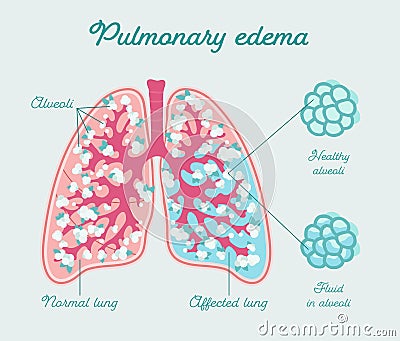 Pulmonary edema, edema of lung. Fluid in alveoli - vector anatomical scheme. Comparison healthy and fill of liquid lungs Vector Illustration