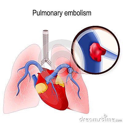 Pulmonary embolism. Human lungs and heart. Vector Illustration