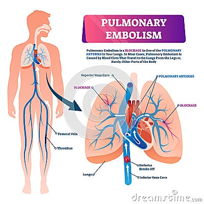 Pulmonary embolism vector illustration. Labeled lung blood blockage scheme Vector Illustration