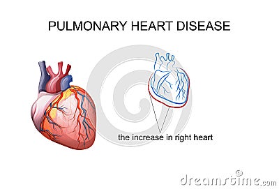 Pulmonary heart disease Vector Illustration