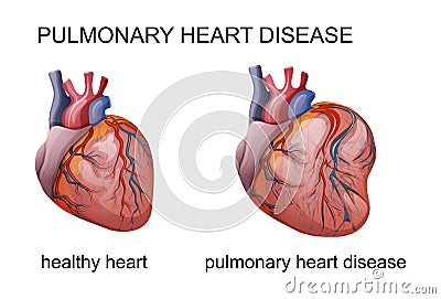 Pulmonary heart disease Vector Illustration