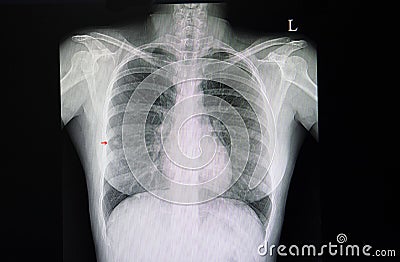 pulmonary nodules Stock Photo