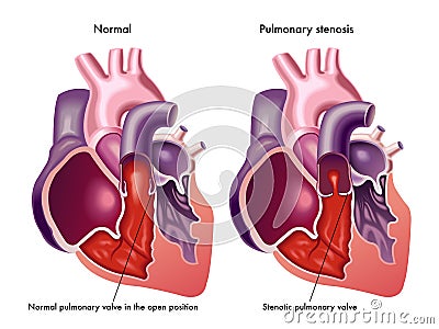 Pulmonary stenosis Vector Illustration