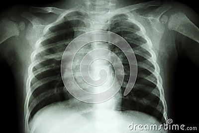 Pulmonary Tuberculosis ( Chest X-ray of child : show patchy infiltration at right middle lung ) Stock Photo