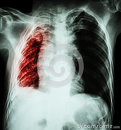 Pulmonary Tuberculosis . Chest X-Ray : Right lung atelectasis and infiltration and effusion due to Mycobacterium Tuberculosis i Stock Photo