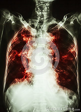 Pulmonary Tuberculosis . film chest x-ray of old patient show interstitial infiltration both lung and calcification at trachea c Stock Photo