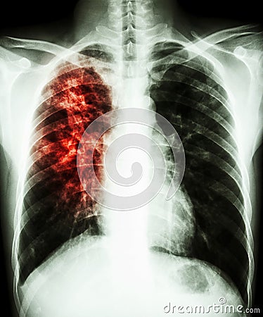 Pulmonary tuberculosis Stock Photo