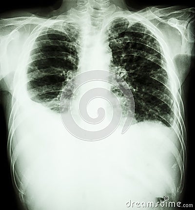 Pulmonary Tuberculosis Stock Photo