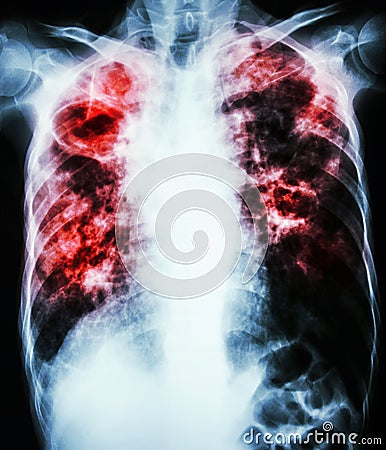 Pulmonary Tuberculosis Stock Photo