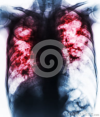 Pulmonary Tuberculosis . Film chest x-ray show fibrosis,cavity,interstitial infiltration both lung due to Mycobacterium tuberculos Stock Photo