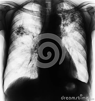 Pulmonary Tuberculosis . Stock Photo