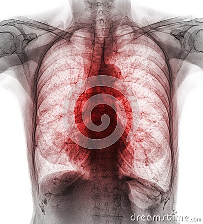 Pulmonary Tuberculosis . Film chest x-ray show interstitial infiltrate both lung due to Mycobacterium tuberculosis infection Stock Photo