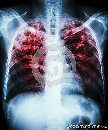 Pulmonary tuberculosis Stock Photo