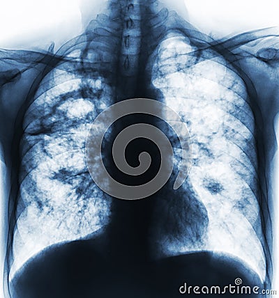 Pulmonary tuberculosis . Film x-ray of chest show cavity at right lung and interstitial infiltrate both lung due to TB infection Stock Photo