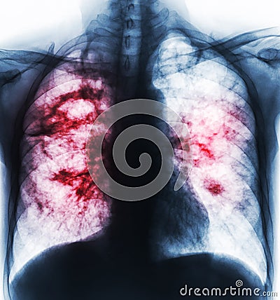 Pulmonary tuberculosis . Film x-ray of chest show cavity at right lung and interstitial infiltrate both lung due to TB infection Stock Photo