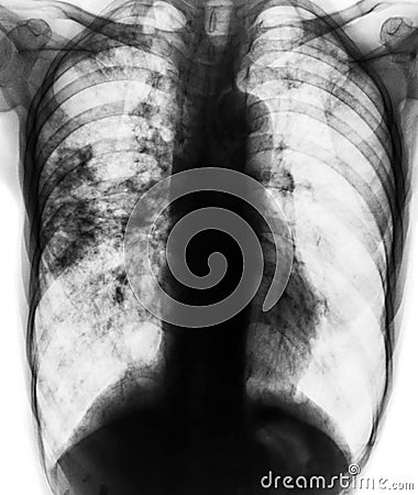 Pulmonary tuberculosis . Film x-ray of chest show patchy infiltrate at right lung due to TB infection Stock Photo