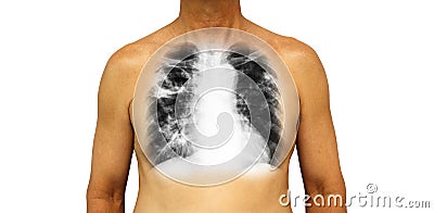 Pulmonary tuberculosis . Human chest with x-ray show cavity at right upper lung and interstitial infiltrate both lung due to infec Stock Photo