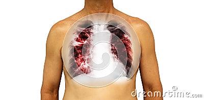 Pulmonary tuberculosis . Human chest with x-ray show cavity at right upper lung and interstitial infiltrate both lung due to infec Stock Photo