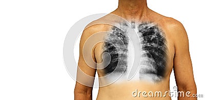 Pulmonary tuberculosis . Human chest with x-ray show interstitial infiltrate both lung due to infection . Isolated background . Bl Stock Photo