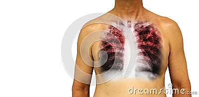 Pulmonary tuberculosis . Human chest with x-ray show interstitial infiltrate both lung due to infection . Isolated background . Bl Stock Photo