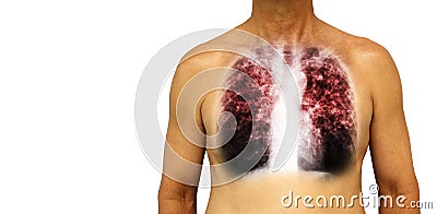Pulmonary tuberculosis . Human chest with x-ray show interstitial infiltrate both lung due to infection . Isolated background . Bl Stock Photo