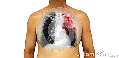 Pulmonary tuberculosis . Human chest with x-ray show patchy infiltrate left upper lung due to infection . Isolated background Stock Photo