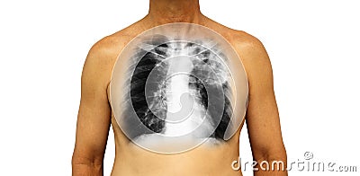 Pulmonary tuberculosis . Human chest with x-ray show patchy infiltrate left upper lung due to infection . Isolated background Stock Photo