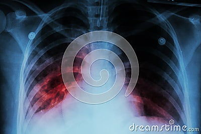 Pulmonary Tuberculosis ( TB ) : Chest x-ray show alveolar infiltration at both lung due to mycobacterium tuberculosis infection Stock Photo