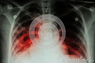 Pulmonary Tuberculosis ( TB ) : Chest x-ray show alveolar infiltration at both lung due to mycobacterium tuberculosis infectionP Stock Photo