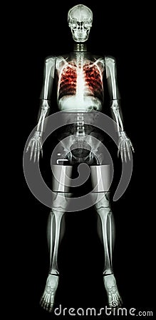 Pulmonary Tuberculosis(TB)(X-ray whole body) Stock Photo