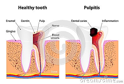 Pulpitis and Healthy tooth Vector Illustration