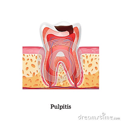 Pulpitis Realistic Illustration Vector Illustration