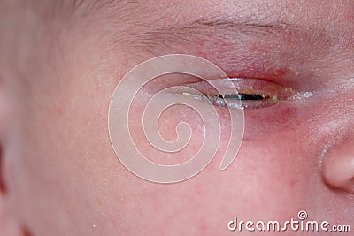 The purulent eye processed by tetracycline ointment Conjunctivitis, treatment of the newborn Stock Photo