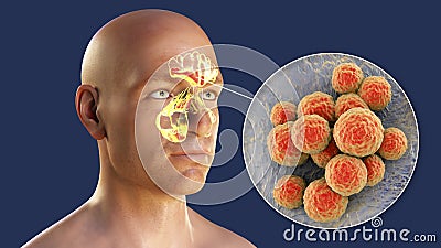 Purulent inflammation of frontal, maxillary, and ethmoid sinuses and close-up view of staphylococcal bacteria Cartoon Illustration