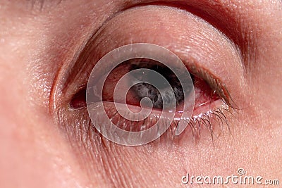 Pus arises from an infected eye. Near Stock Photo