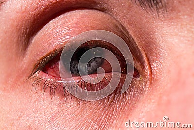 Pus arises from an infected eye. Near Stock Photo
